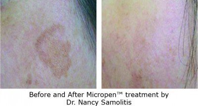 Irvine melasma treatment patient before and after