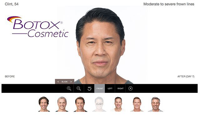 botox results for men