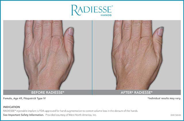 Irvine hand treatment before and after