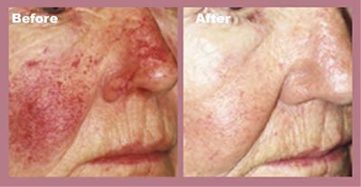 Irvine rosacea patient before and after