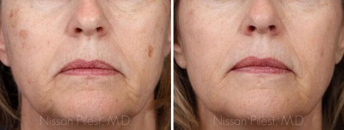 Irvine Brown Spot Treatment Orange County