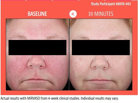 Irvine Rosacea treatment patient before and after