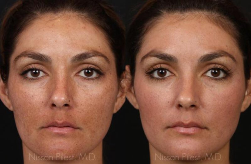 COSMELAN Peel Before & After Irvine, CA