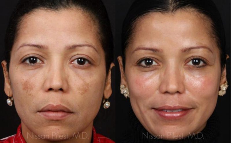 COSMELAN Peel Before & After Irvine, CA