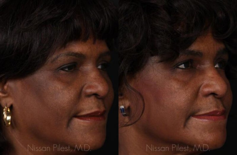 COSMELAN Peel Before & After Irvine, CA