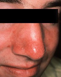 Irvine rosacea patient