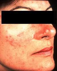 Irvine rosacea patient