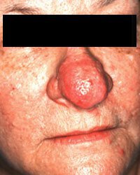 Irvine rosacea patient