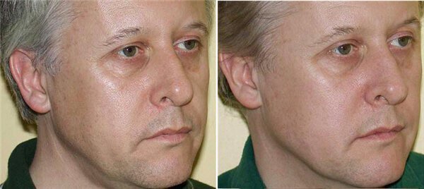 Irvine skin tightening treatment for Men Before & After