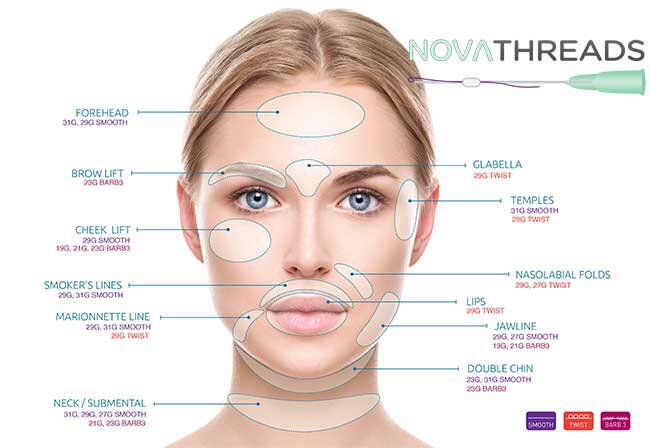 Novathread treatment areas on face