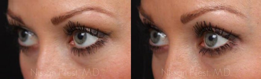 Irvine under-eye hollow treatment before and after