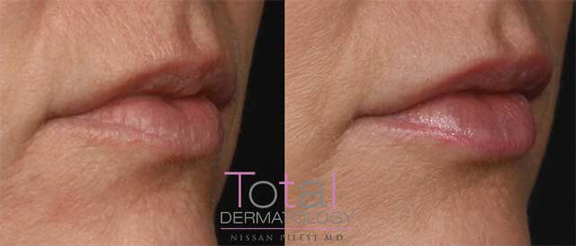 Volbella Lips Before and After Photos