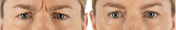 Xeomin Injections Before & After Irvine, CA