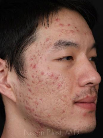 Acne Before & After Image