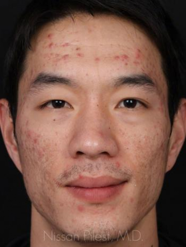 Acne Before & After Image