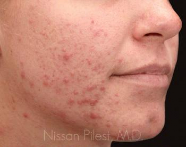 Acne Before & After Image