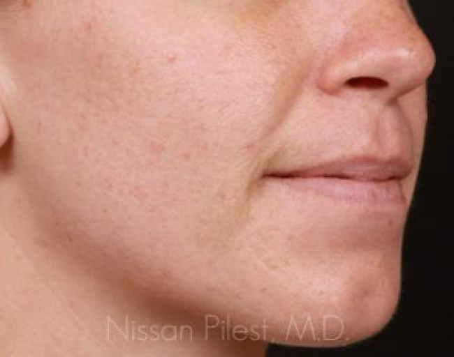 Acne Before & After Image