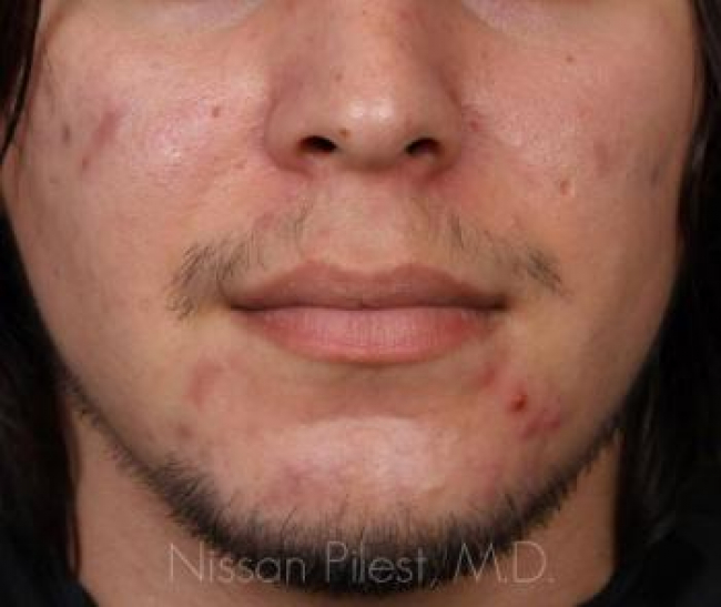 Acne Before & After Image