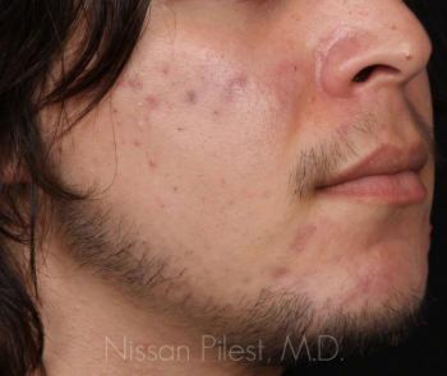 Acne Before & After Image