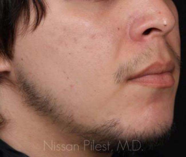 Acne Before & After Image