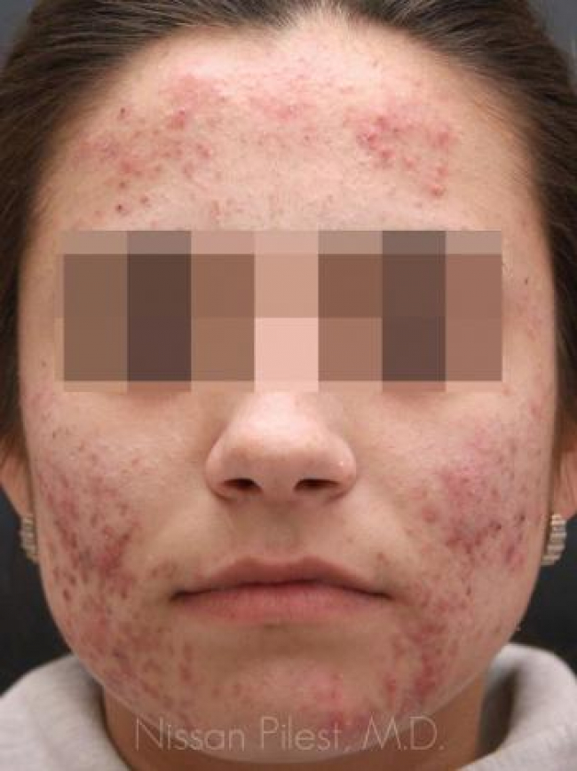 Acne Before & After Image