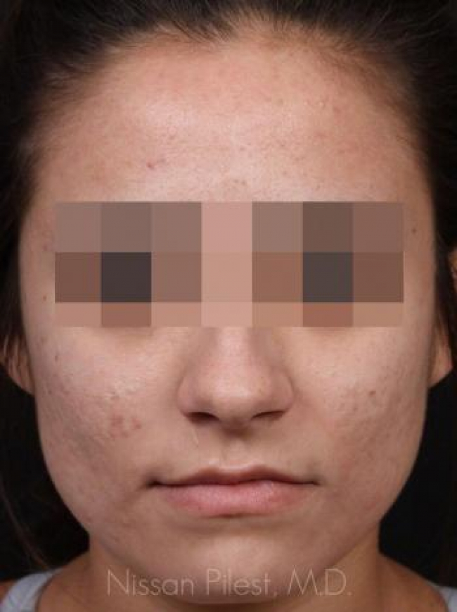 Acne Before & After Image