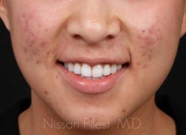 Acne Before & After Image