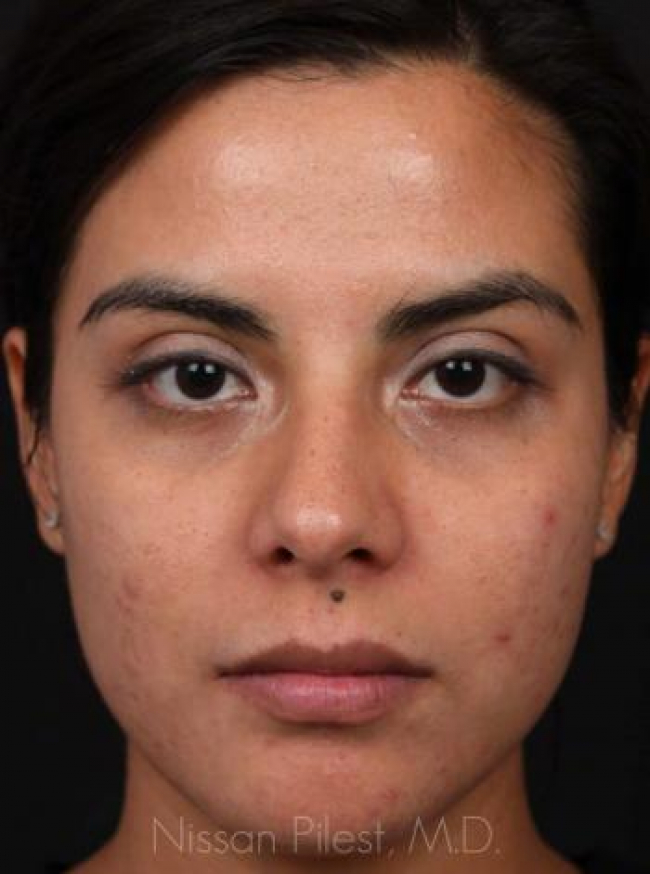 Acne Before & After Image