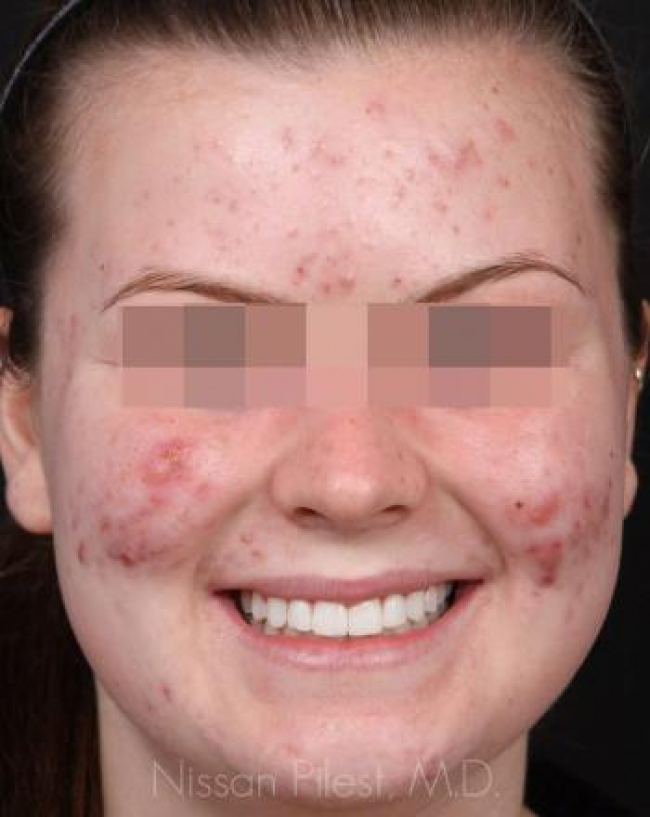 Acne Before & After Image