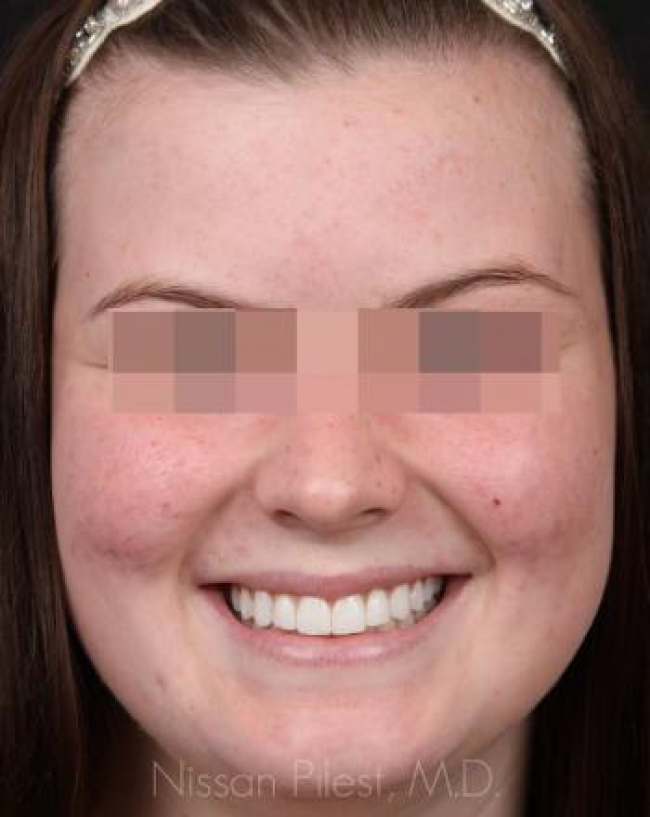 Acne Before & After Image