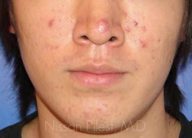 Acne Before & After Image