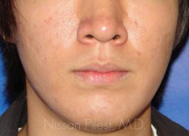 Acne Before & After Image