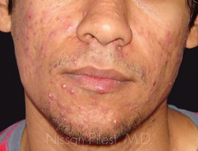 Acne Before & After Image