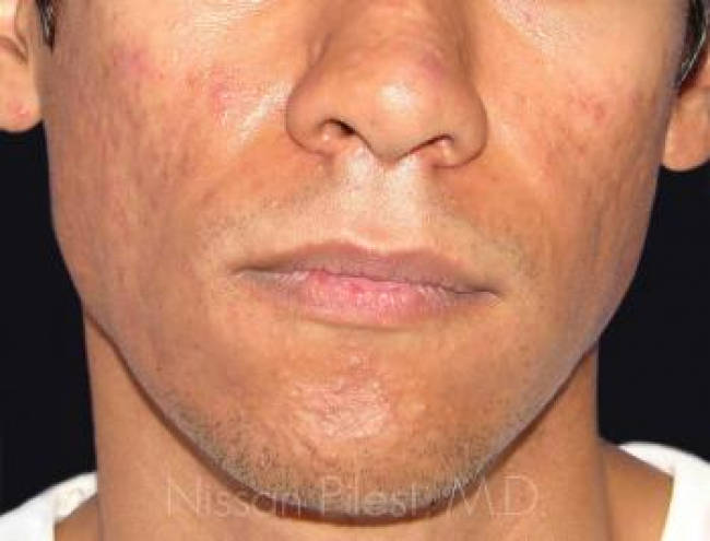 Acne Before & After Image