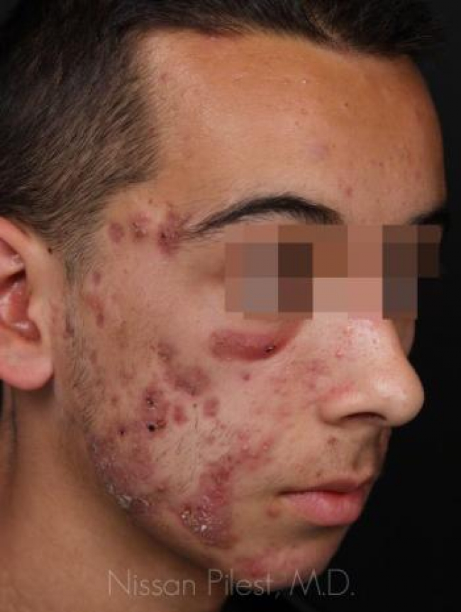 Acne Before & After Image