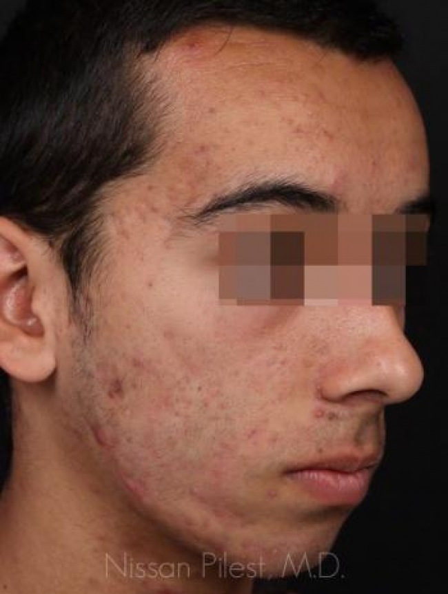 Acne Before & After Image