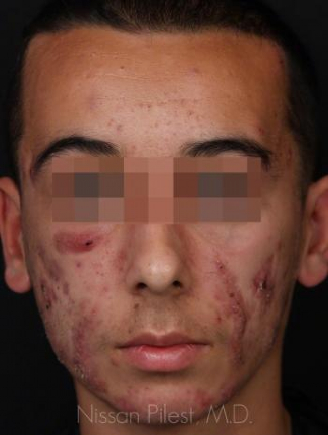 Acne Before & After Image