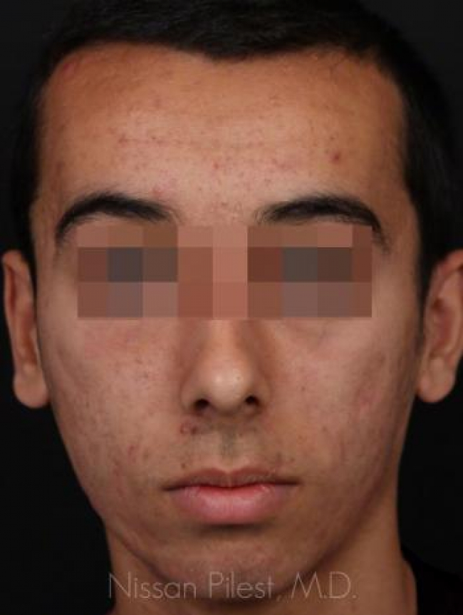 Acne Before & After Image