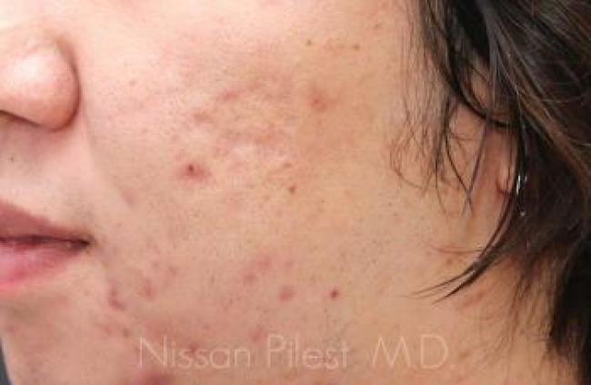 Acne Before & After Image