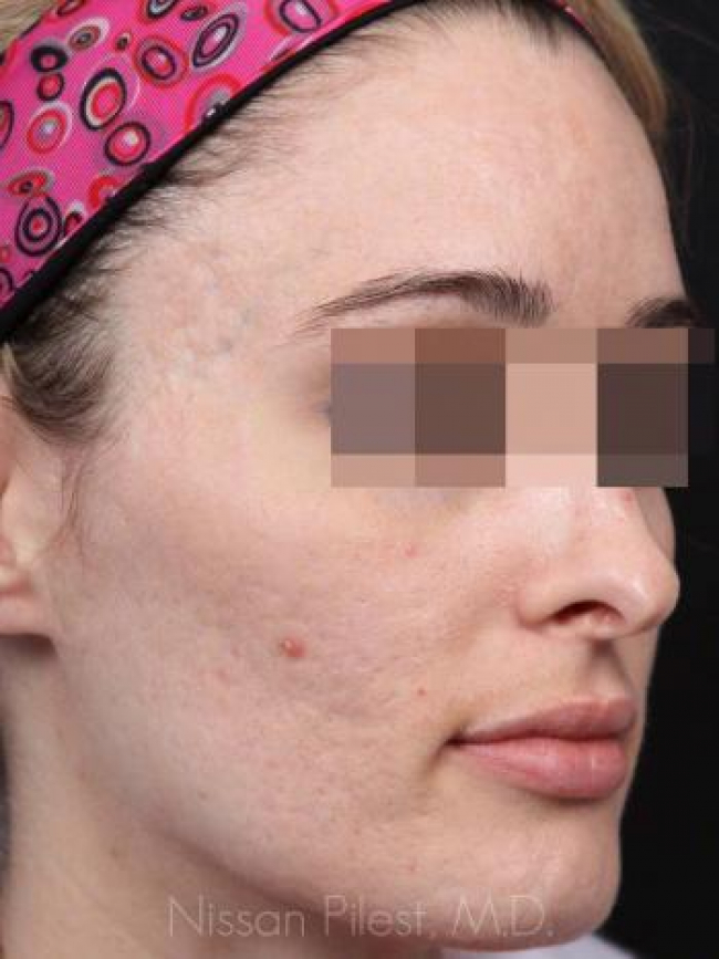 Acne Before & After Image