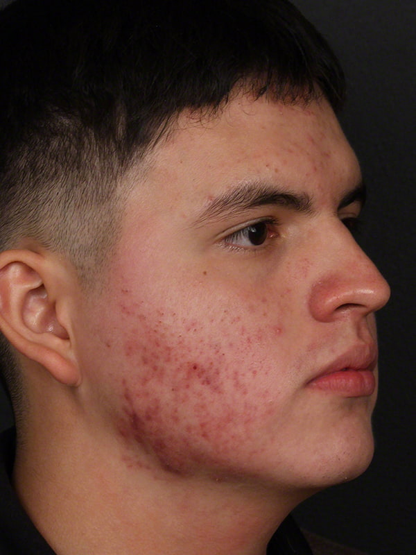 Acne Before & After Image