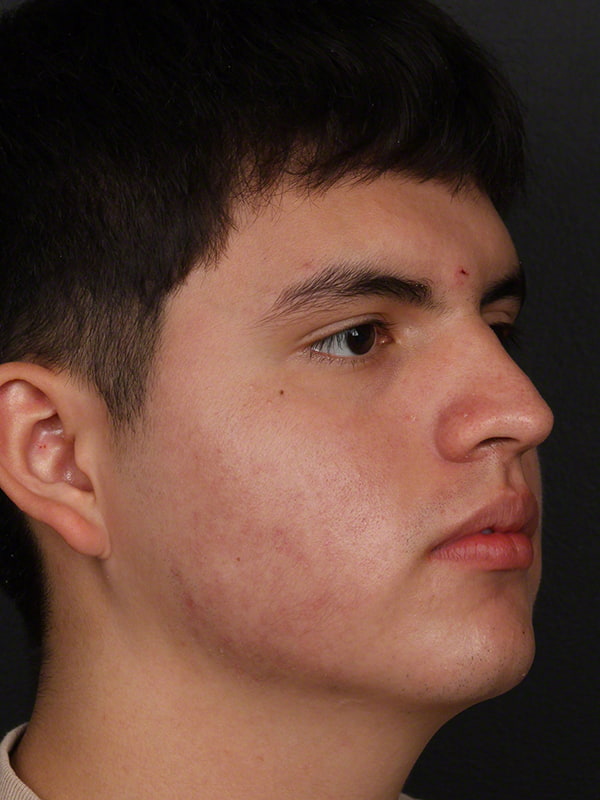 Acne Before & After Image