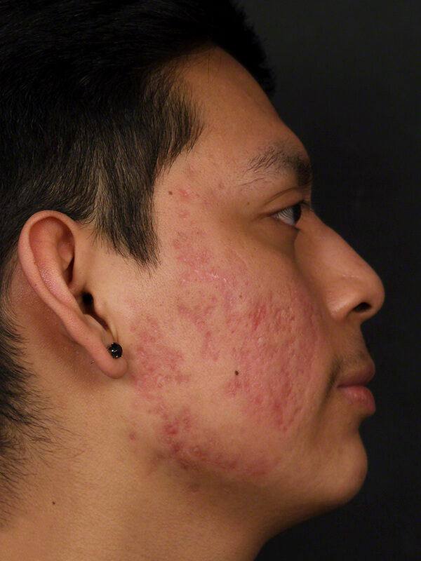 Acne Before & After Image