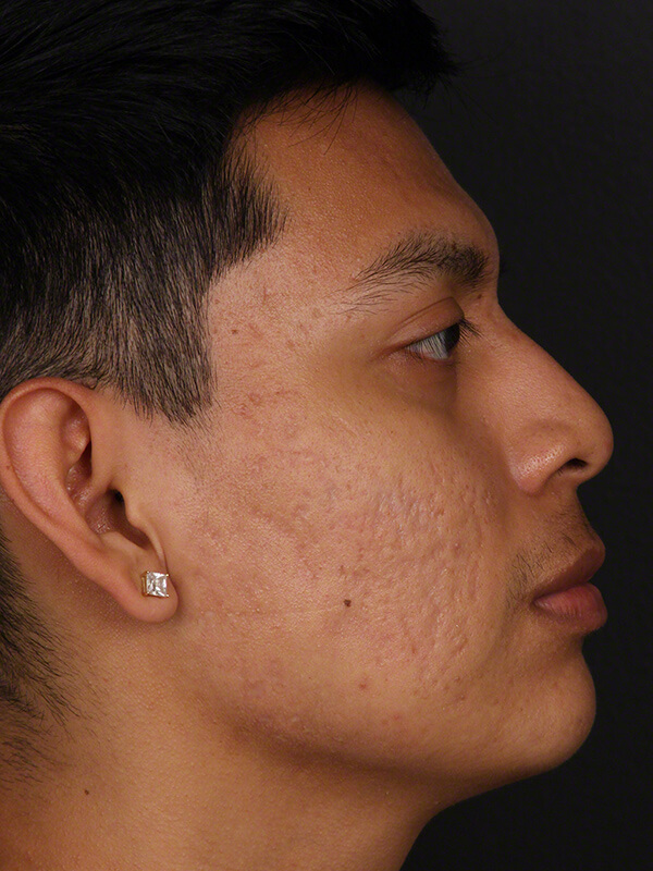 Acne Before & After Image