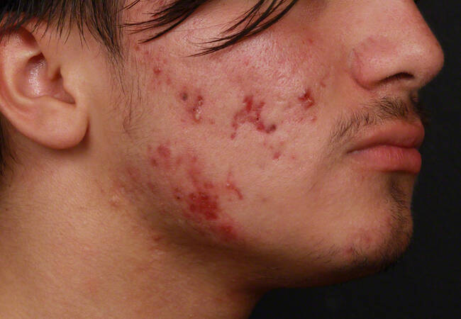 Acne Before & After Image