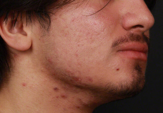 Acne Before & After Image