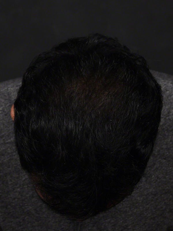 Anti Aging Before & After Image