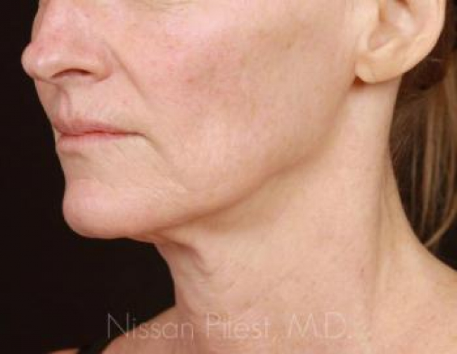 Contouring & Tightening Before & After Image