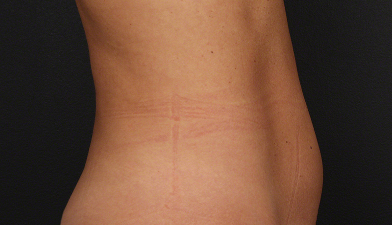 Contouring & Tightening Before & After Image