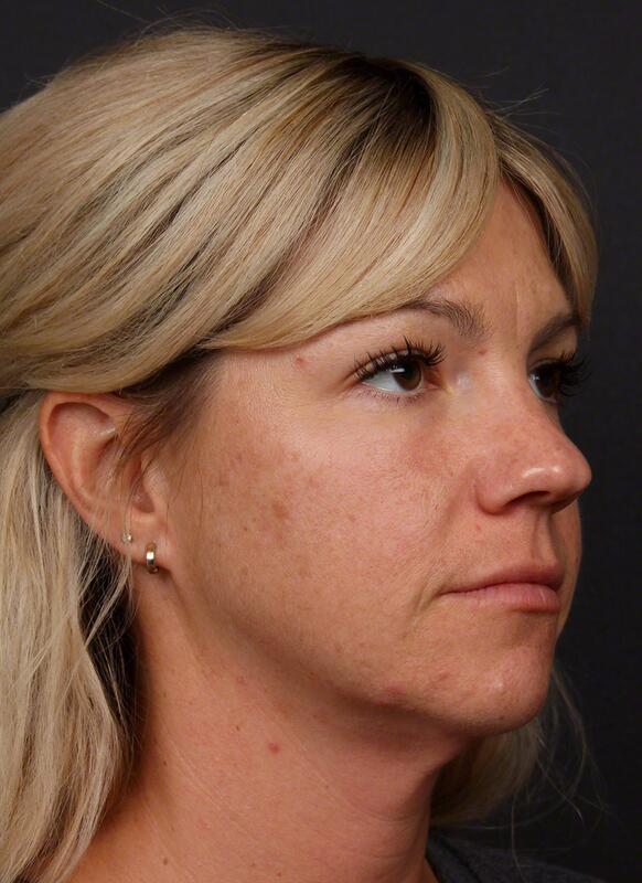 Contouring & Tightening Before & After Image